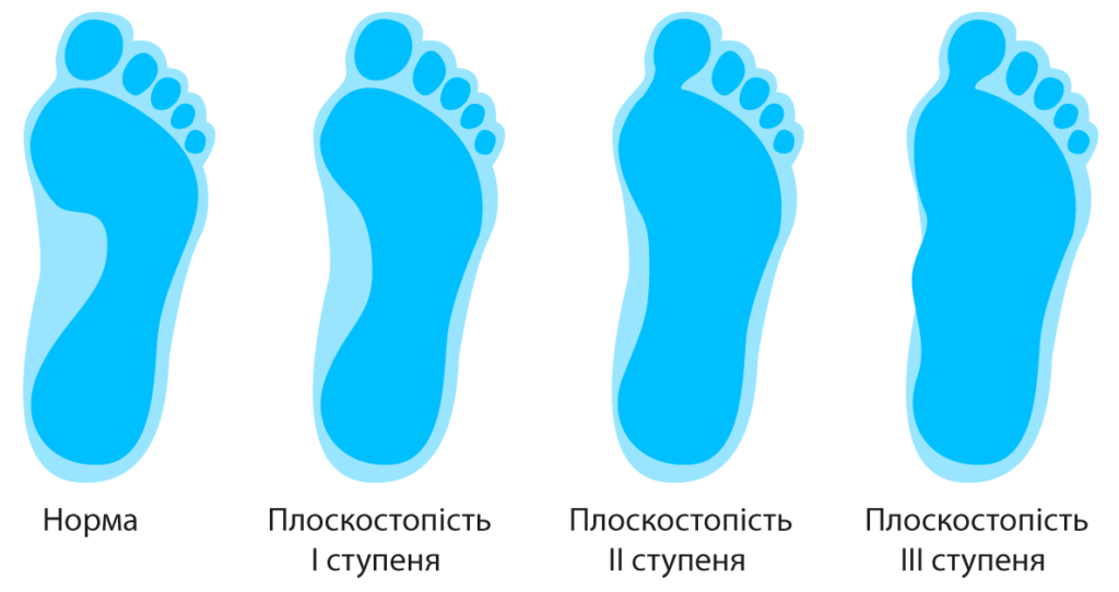 плоскостопість у дітей що робити