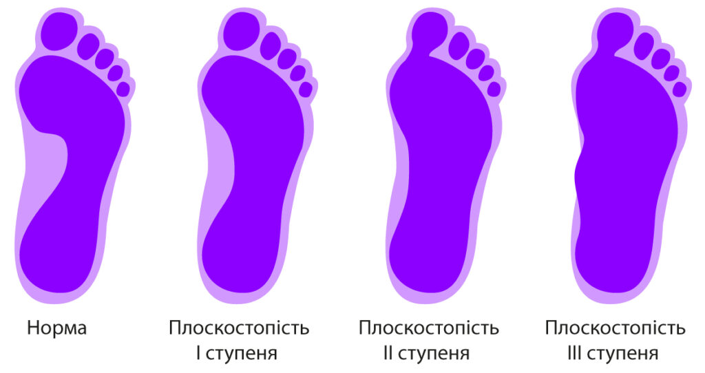 как выглядит плоскостопие у детей