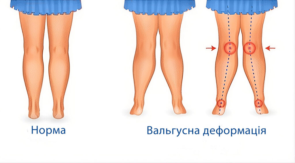 вальгус у детей